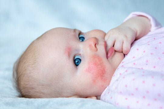 Don’t Buy Baby Eczema Cream Yet: Why Treating the Root Cause Matters More