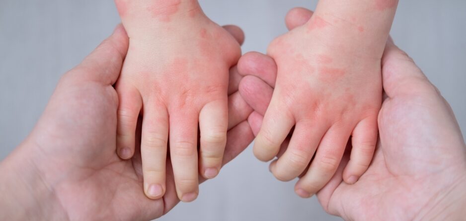 Why is My Baby’s Skin So Sensitive? : Understanding the Probiotic Shower